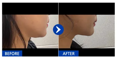 [カンナムオンニ] 顔の脂肪吸引 1ヶ月目 / ニックネーム : mj_park