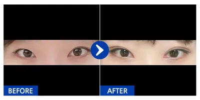 [カンナムオンニ] 自然癒着(二重術)、目頭切開、目つき矯正 1ヶ月目 / ニックネーム：ポハハンプハハン