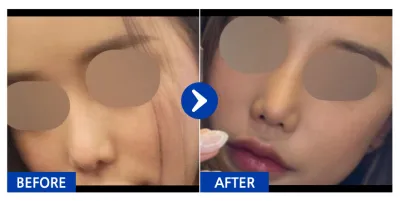 [カンナムオンニ] 鼻再手術 1ヶ月目 / ニックネーム: huisll_day