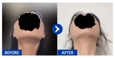 [カンナムオンニ] 頬骨1ヶ月目 / ニックネーム：ハハハハハハハマ