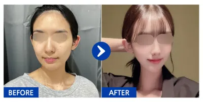 [カンナムオンニ] 輪郭2点(エラ、頬骨) 1ヶ月目 / ニックネーム：トゥユリ