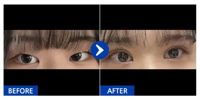 [カンナムオンニ] 二重（切開）、目つき矯正 1ヶ月目 / ニックネーム：ヨンチョグ