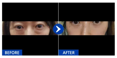 [カンナムオンニ] 目の下の脂肪再配置、前頬の脂肪移植 1ヶ月目 / ニックネーム：ラララランイン