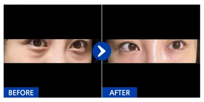 [カンナムオンニ] 目の下の脂肪再配置 7日目 / ニックネーム：ドンジグムジ