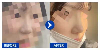 [カンナムオンニ] 鼻整形 1ヶ月目 / ニックネーム : luckyyeji