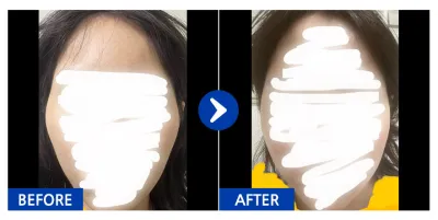 [カンナムオンニ] 頬骨 1ヶ月目 / ニックネーム : qweasdfgh