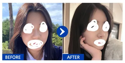 [カンナムオンニ]鼻整形、脂肪移植 1ヶ月目 / ニックネーム：sunbini