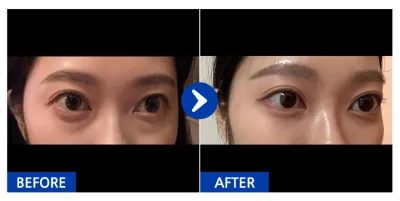 [カンナムオンニ] 目の下の脂肪再配置 1ヶ月目_liina_