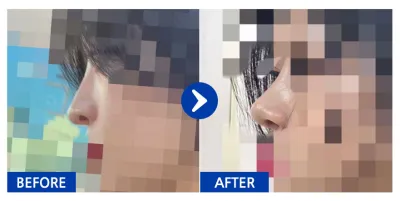 [カンナムオンニ] 鼻整形 1ヶ月目_aaaa1212