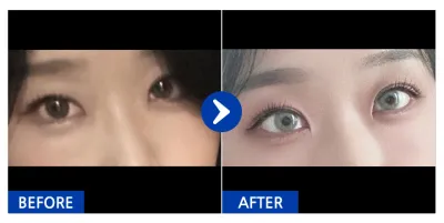 [カンナムオンニ] 目の下の脂肪再配置 / 1ヶ月目 / ニックネーム：hyupp_