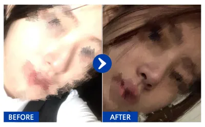 [バビトーク] 鼻整形 1ヶ月目/ ニックネーム: ニャンイgRtzK