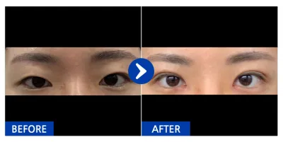 [カンナムオンニ] 二重、目頭切開、目つき矯正 / 1ヶ月目 / ニックネーム：ウビラアレベプ