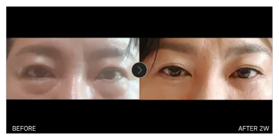 [カンナムオンニ 口コミ] 下眼瞼＋糸リフト 2週目 / ニックネーム：ガニシニ