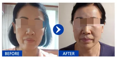 [バビトーク] 糸リフト 1ヶ月目 / ニックネーム：ニャンイb6sKx