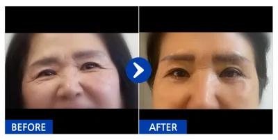 [カンナムオンニ] 眉下切開、下眼瞼 / 1ヶ月目 / ニックネーム：チャムシルジャネ