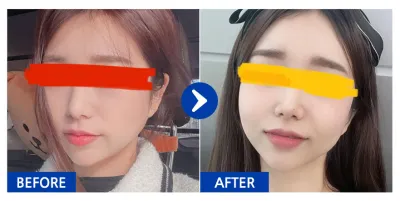 [バビトーク] フルフェイス脂肪移植 / 1ヶ月目 / ニックネーム：ジュユビ