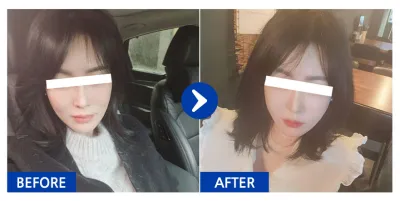 [バビトーク] フルフェイス脂肪移植、糸リフト / 2週目 / ニックネーム：갱쥐zXzo