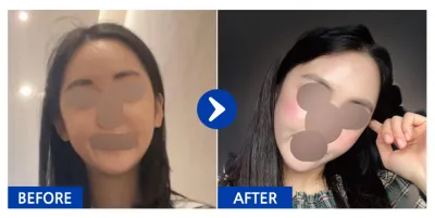 [カンナムオンニ] フルフェイス脂肪移植 / 1ヶ月目 / ニックネーム：綺麗になろうよぉぉ