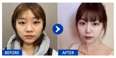 [カンナムオンニ 口コミ] 鼻整形 / 3ヶ月目 / ニックネーム：ウンナンナン