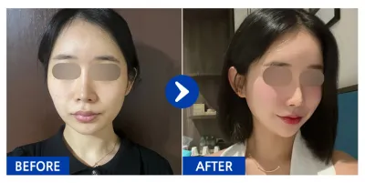 [カンナムオンニの口コミ] 輪郭3点(頬骨、顎先、エラ)、豊胸(メンタースムース) / 3ヶ月目 / ニックネーム:クルルルッピンポン