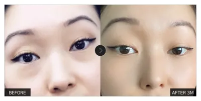 [カンナムオンニ レビュー] 目の下の脂肪再配置 3ヶ月目 / ニックネーム：ケグリワンヌン