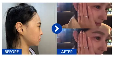 [カンナムオンニ 口コミ] 鼻の再手術 / 3週目 / ニックネーム：ハイルーイクバ