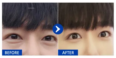 [カンナムオンニ] 目の下の脂肪再配置 1ヶ月目 / ニックネーム：クリス