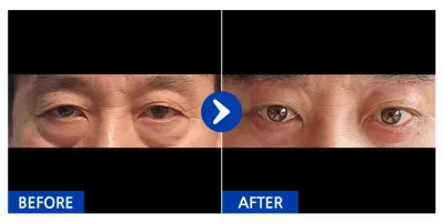 [カンナムオンニ] 下眼瞼、眉下リフト / 1ヶ月目 / ニックネーム：ビージェイティ