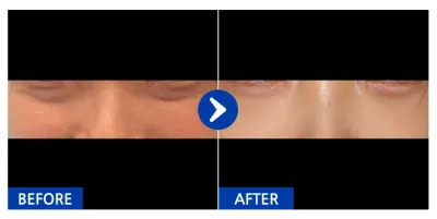 [カンナムオンニ] 目の下の脂肪再配置 1ヶ月目 / ニックネーム：ミㅣミミミㅣ