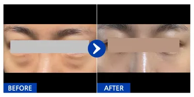 [カンナムオンニ] 目の下の脂肪再配置 / 1ヶ月目 / ニックネーム：プエンエウ