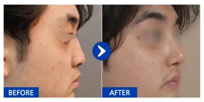 [カンナムオンニ] 鼻整形 / 1ヶ月目 / ニックネーム：ドライマンゴー愛好家