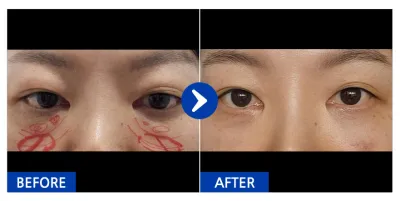 [カンナムオンニ] 目の下の脂肪再配置 / 1ヶ月目 / ニックネーム：ユリアル76