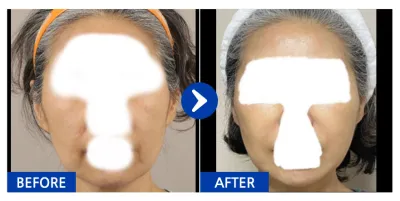 [カンナムオンニ] 切開リフト / 1ヶ月目 / ニックネーム：アンニョンオンニンニン