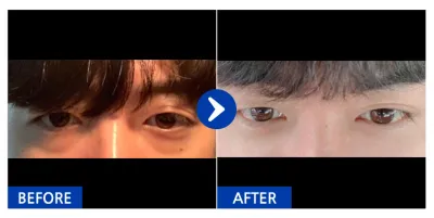 [カンナムオンニ] 目の下の脂肪再配置 / 1ヶ月目 / ニックネーム：キム・ドンウン