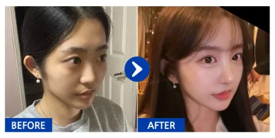 [カンナムオンニ レビュー] 鼻整形、額脂肪移植 / 1週目 / ニックネーム：ニャンニャンニャンウンウン