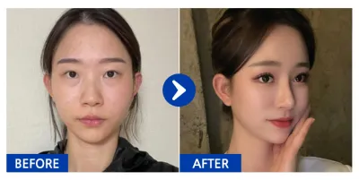 [バビトーク口コミ] 目再手術、鼻、胸（モティバ）、脂肪移植（額・前頬骨）、輪郭2点 / 6ヶ月目 / ニックネーム：デュデュデュジュジュ