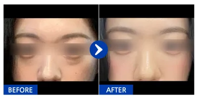 [カンナムオンニ] 目の下の脂肪再配置 / 1ヶ月目 / ニックネーム：ミンミンハンギュル