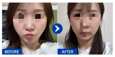 [カンナムオンニ] 頬骨 / 1ヶ月目 / ニックネーム：チニイエオン