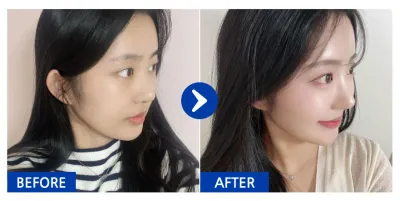 [バビトーク] 鼻整形、額脂肪移植 / 2週目 / ニックネーム：ニャンニャンニャンウンウン