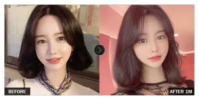 [バビトーク口コミ] 目整形 1ヶ月目 / ニックネーム : y3409