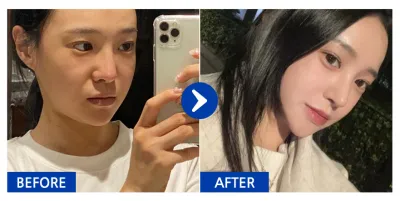 [バビトーク] 鼻整形 / 1週目 / ニックネーム：クオッカu0VdN