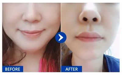 [カンナムオンニ 口コミ] ミニ切開リフト / 1ヶ月目 / ニックネーム：ホンデ魔女