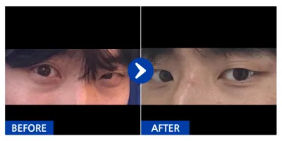 [カンナムオンニ] 目の下の脂肪再配置 / 3ヶ月目 / ニックネーム：シンバンベク先生