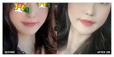 [カンナムオンニ レビュー] 輪郭整形 2ヶ月目 / ニックネーム：yrBang