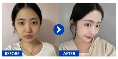 [カンナムオンニ] 鼻整形 / 3ヶ月目 / ニックネーム:ニャンニャンニャンウンウン