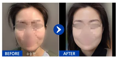 [バビトーク] 輪郭2点(頬骨、エラ) / 1ヶ月目 / ニックネーム:ウサギ65Nsj