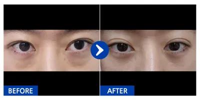 [バビトーク] 目の下の脂肪再配置 / 1ヶ月目 / ニックネーム：냥이KdOcl