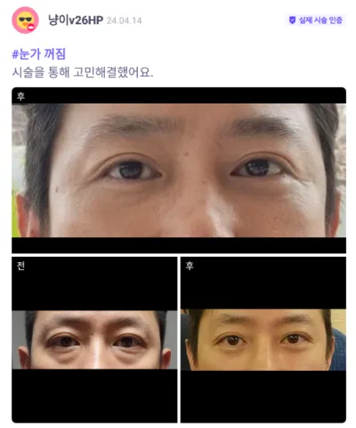 [バビトーク] 目の下の脂肪再配置 / 2ヶ月目 / ニックネーム:ニャンイv26HP