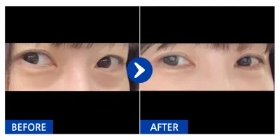 [カンナムオンニ] 目の下の脂肪再配置 / 1ヶ月目 / ニックネーム：ムンテン