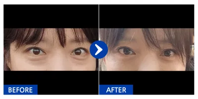 [カンナムオンニ] 目の下の脂肪再配置 / 1ヶ月目 / ニックネーム：アイスピア